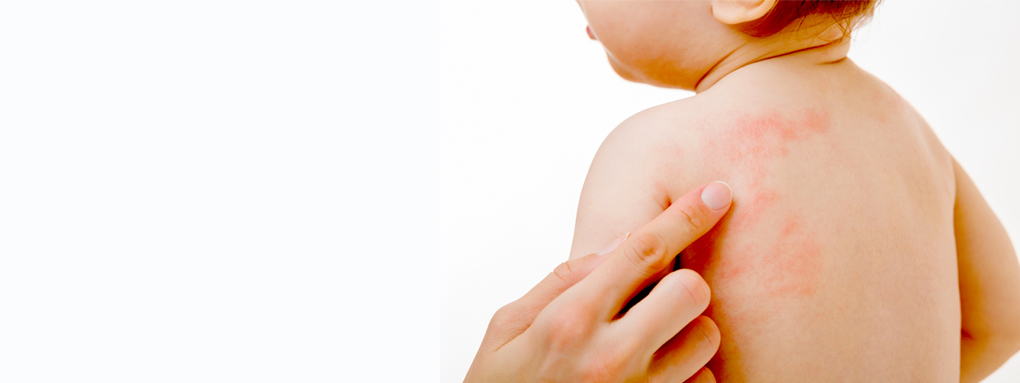Haridra (Curcuma longa) in pediatric allergy and immune modulation